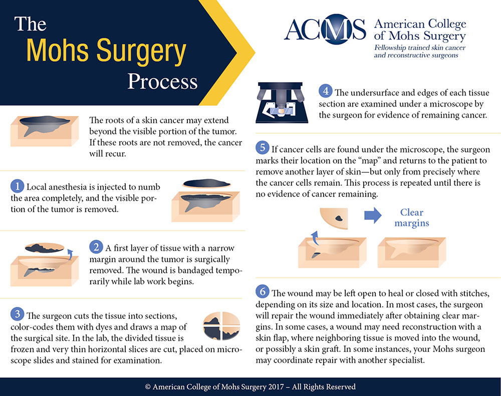 ACMS Mohs Surgery Process Infographic